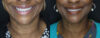 Fat Grafting case #7587 slider thumbnail