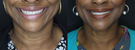 Fat Grafting case #7587