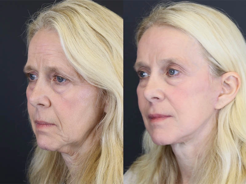 Brow Lift case #7418