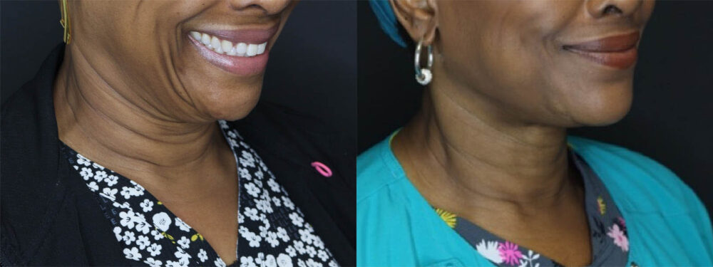 Fat Grafting case #7587