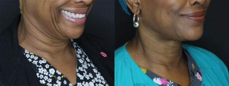 Fat Grafting case #7587