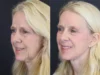 Brow Lift case #7418 slider thumbnail
