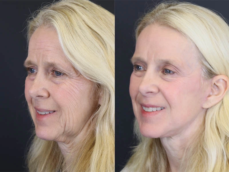 Brow Lift case #7418