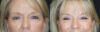 Blepharoplasty case #7336 slider thumbnail