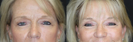 Blepharoplasty case #7336