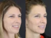 Facelift case #7463 slider thumbnail
