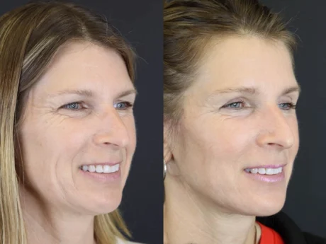 Facelift case #7463