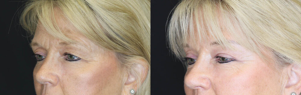 Blepharoplasty case #7336