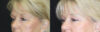Blepharoplasty case #7336 slider thumbnail