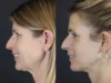 Facelift case #7463 slider thumbnail