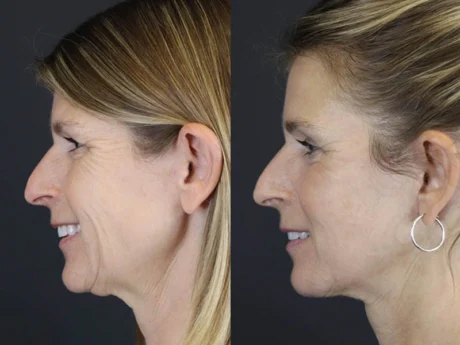 Facelift case #7463
