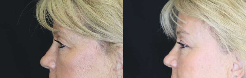 Blepharoplasty case #7336