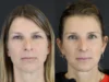 Facelift case #7463 slider thumbnail