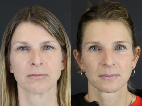 Facelift case #7463