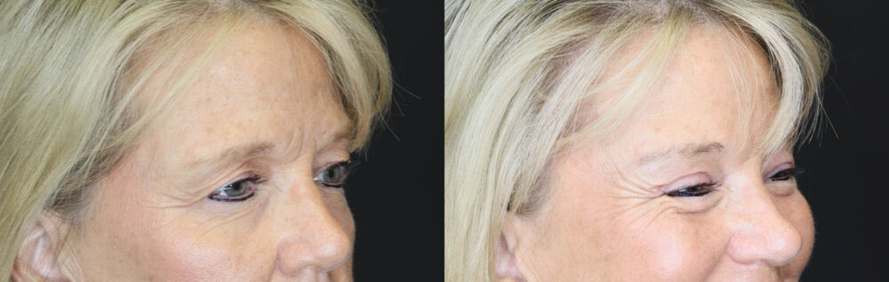 Blepharoplasty case #7336