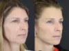 Facelift case #7463 slider thumbnail