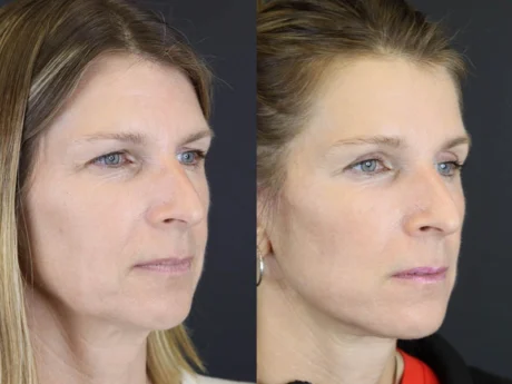 Facelift case #7463