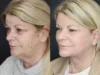Deep Chemical Peel case #7578 slider thumbnail