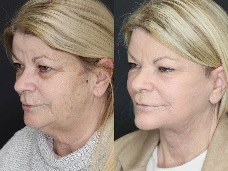 Deep Chemical Peel case #7578
