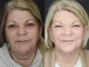 Deep Chemical Peel case #7578 slider thumbnail