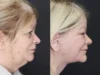 Deep Chemical Peel case #7578 slider thumbnail