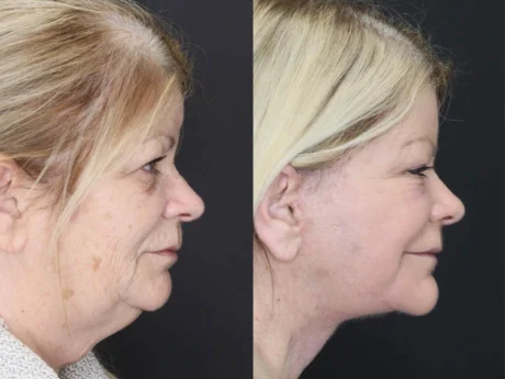 Deep Chemical Peel case #7578