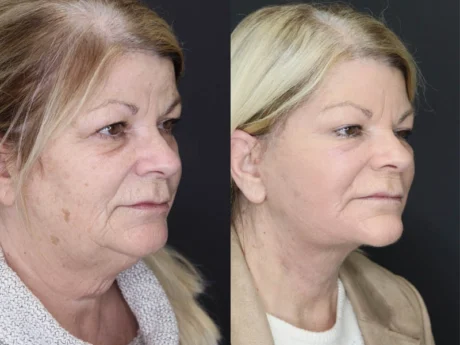 Deep Chemical Peel case #7578