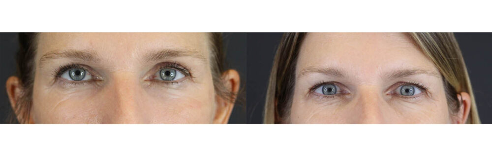 Blepharoplasty case #7482
