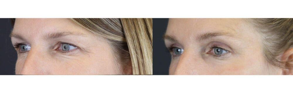 Blepharoplasty case #7482