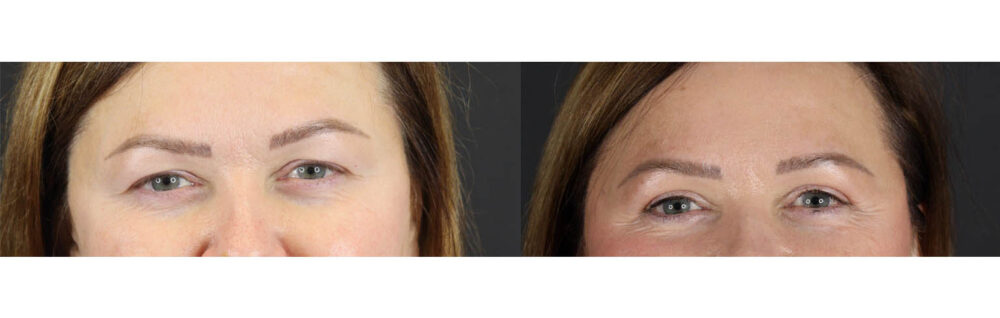 Blepharoplasty case #7483