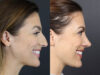 Rhinoplasty case #8392 slider thumbnail