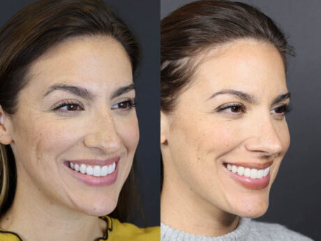 Rhinoplasty case #8392