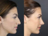 Rhinoplasty case #8392 slider thumbnail