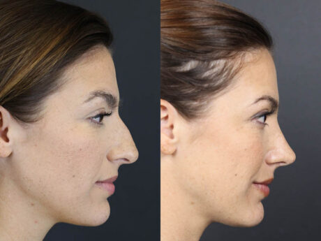 Rhinoplasty case #8392