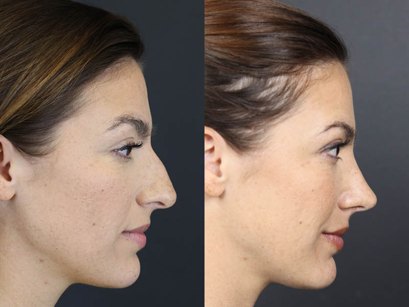 Rhinoplasty case #8392