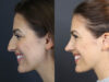 Rhinoplasty case #8392 slider thumbnail