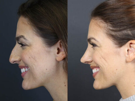 Rhinoplasty case #8392