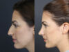 Rhinoplasty case #8392 slider thumbnail