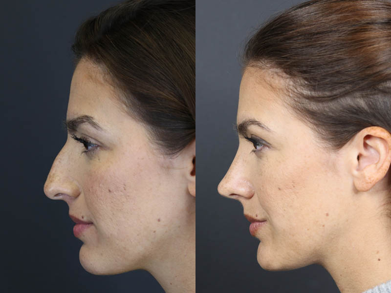 Rhinoplasty case #8392