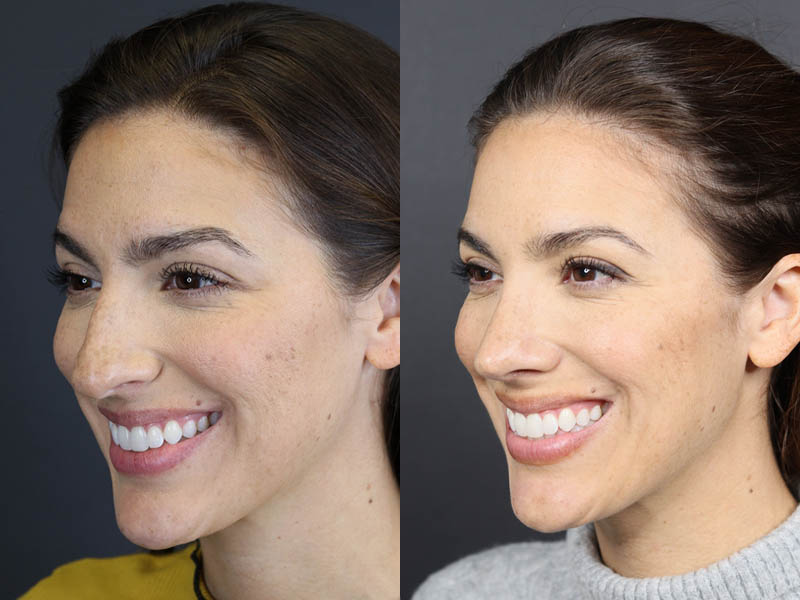 Rhinoplasty case #8392