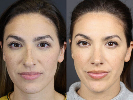 Rhinoplasty case #8392