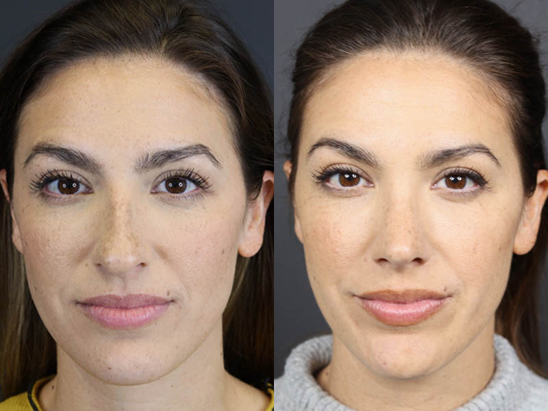 Rhinoplasty case #8392