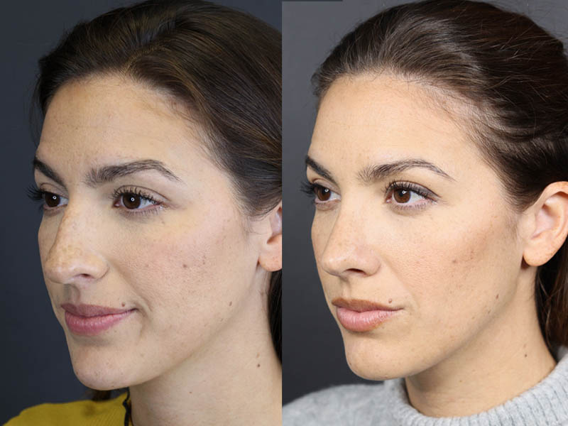 Rhinoplasty case #8392