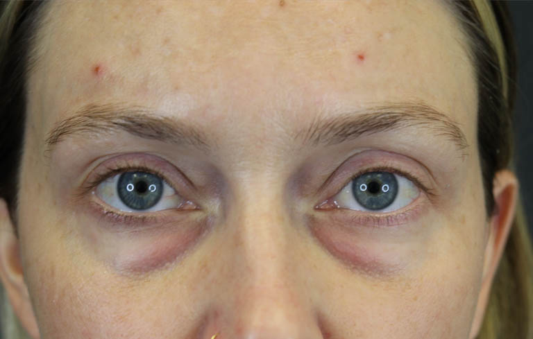 Blepharoplasty case #8411