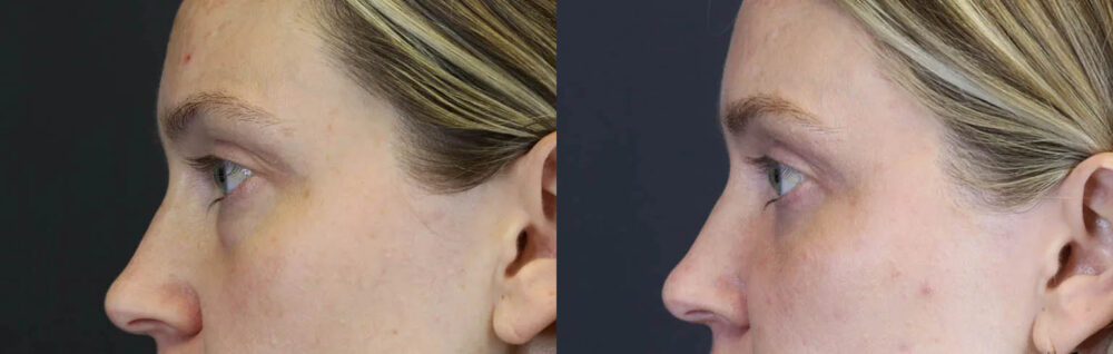 Blepharoplasty case #8411