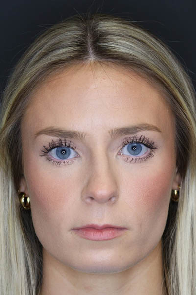Rhinoplasty case #8344