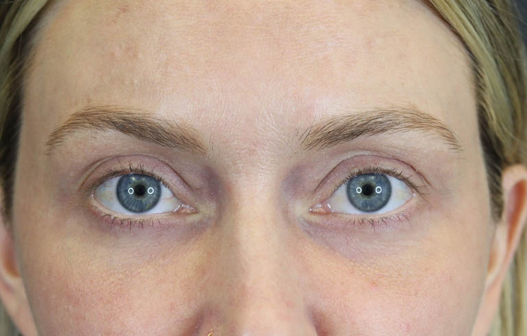 Blepharoplasty case #8411