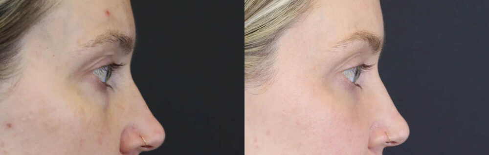 Blepharoplasty case #8411