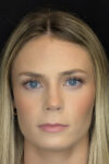 Rhinoplasty case #8344