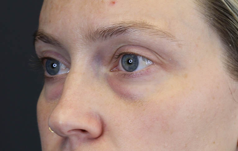 Blepharoplasty case #8411